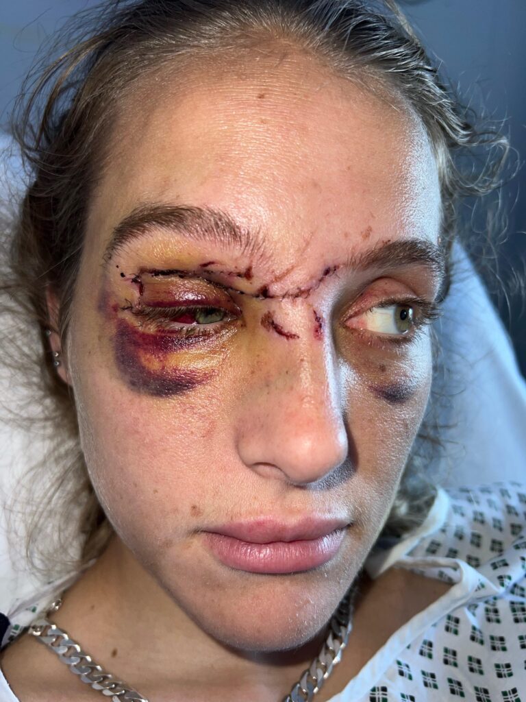 British model Mercedes Valentine says her nurse boyfriend’s intimate support during her hospital recovery after a horrific motorbike crash helped her regain confidence and hope.