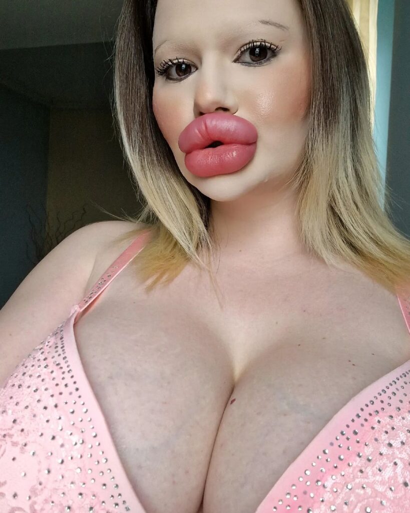 Influencer known for the world’s biggest lips says she was rejected by The Bachelor because of her extreme look and now hopes to find love with someone who accepts her fully.