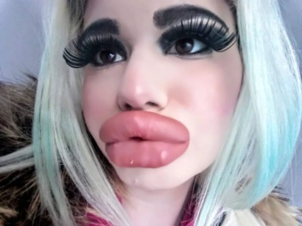 Influencer known for the world’s biggest lips says she was rejected by The Bachelor because of her extreme look and now hopes to find love with someone who accepts her fully.