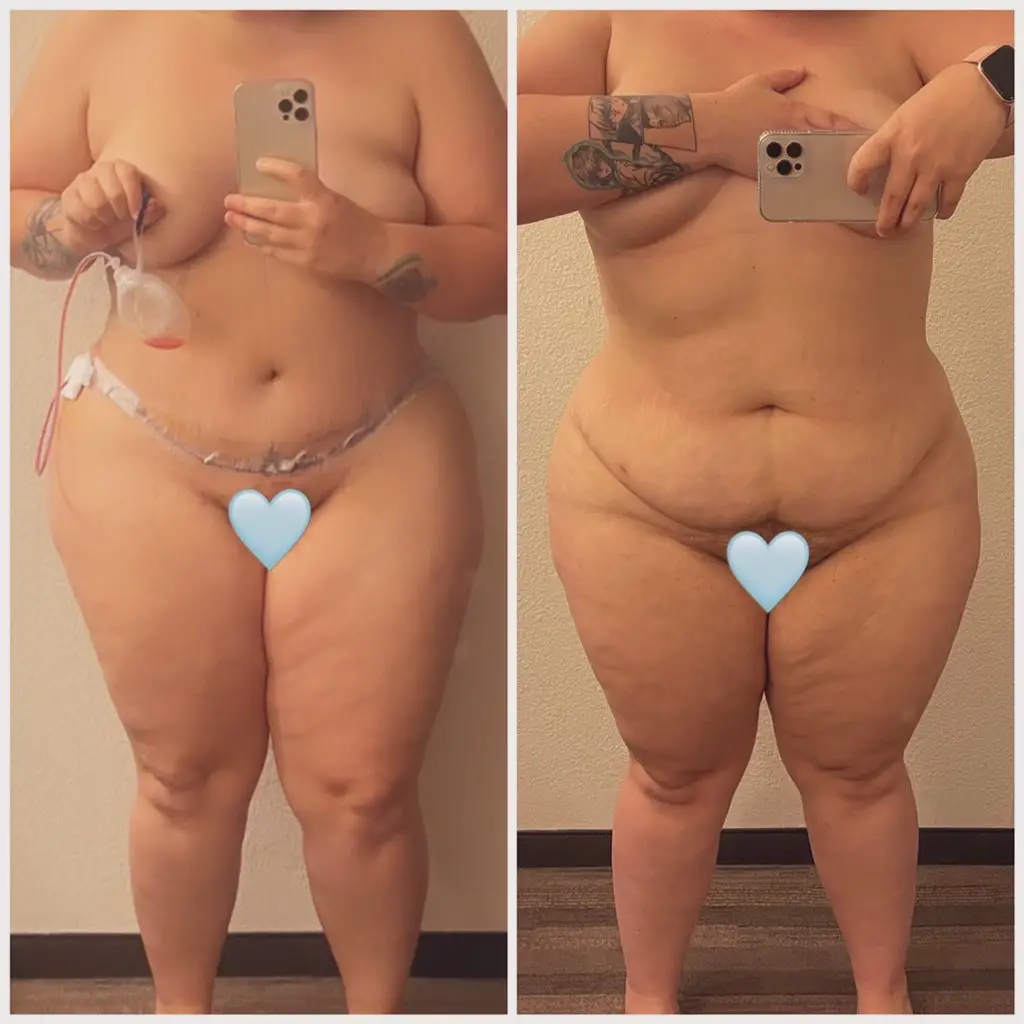 Meagan Starke before and after tummy tuck surgery.
